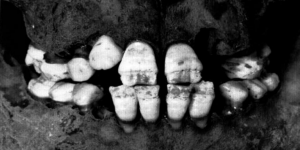 Figure 2: DEH on the enamel of the incisors observed in a non-adult from the post-medieval London Spitalfields population (Molleson and Cox 1993, 62).