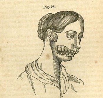 Figure 15: Phosphorous exposure. Image is taken from http://lateralscience.blogspot.com/2017/09/phossy-jaw-white-phosphorus-causes.html. Extracted 18.10.19.