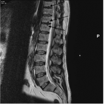 Figure 2: Magnetic resonance imaging of thorax spine indicating Schmorl's nodes present on T9, T11 and T12 of vertebral surfaces (Williams et al. 2007, 856).